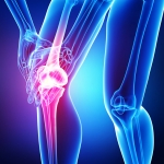Stem Cell Therapy For A Meniscus Tear (New York)